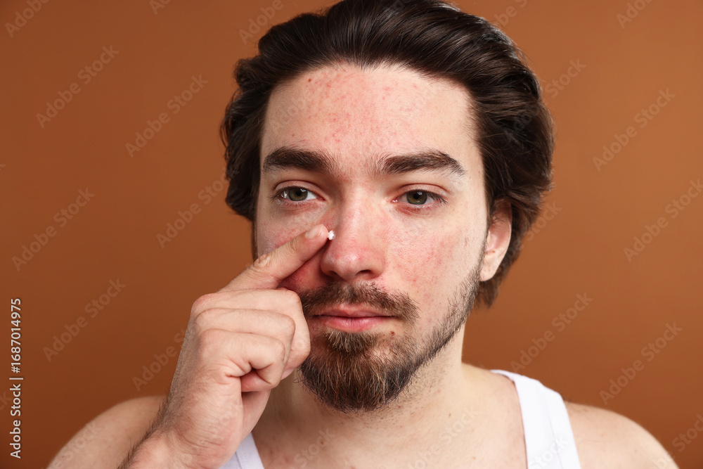 Obraz premium Young man with acne problem applying cream onto his face on brown background