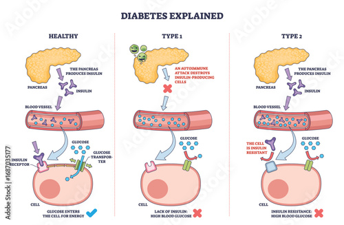 Diabetes types explained with an outline diagram showing pancreas, blood vessel, and cell to illustrate insulin function and glucose uptake. Outline diagram