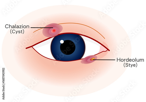 Hordeolum, chalazion. Swellings caused by the obstruction or inflammation of the sebaceous glands in the eyelid. Hordeolum is a common painful infection of the eyelid margin. Vector illustration