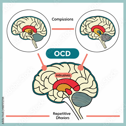 Understanding the Neurological Basis of Obsessive-Compulsive Disorder