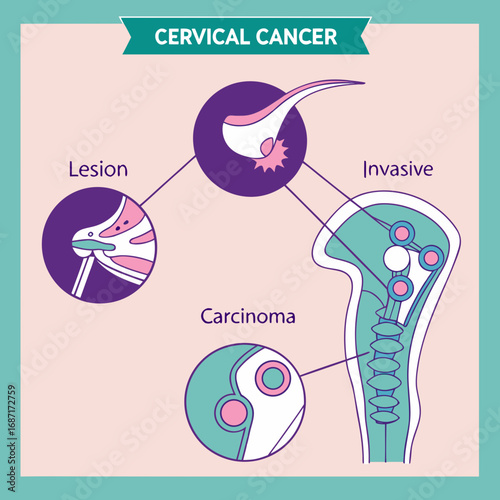 Cervical Cancer Stages and Progression Visual