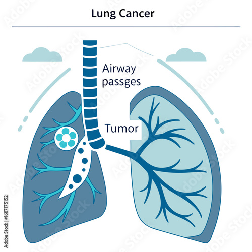 Lung Cancer Illustration Showing Tumor Growth