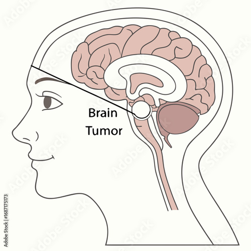 Brain Tumor Anatomy Diagram Medical Illustration