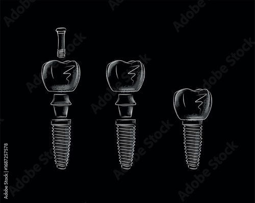 Tooth implant parts illustration drawing in graphic style with white on black background.