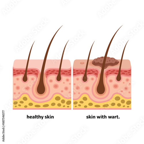 Comparison of healthy skin cross section versus skin with a wart