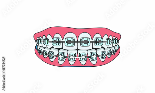 Detailed illustration of a human mouth with metal orthodontic braces, showing brackets and wires on teeth.