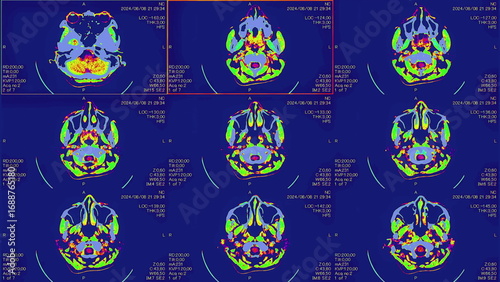 Magnetic resonance images of the brain, MRI of the brain, of a patient with multiple vascular infarctions, front view, color animation Seamless Loop. High quality 4k footage
