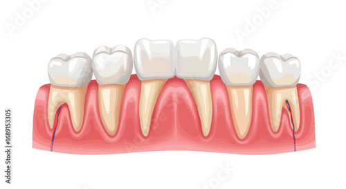 Illustration of a dental bridge, showcasing the replacement of missing teeth with artificial ones.