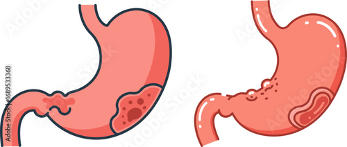 Stomach anatomy illustration showing healthy and diseased conditions  