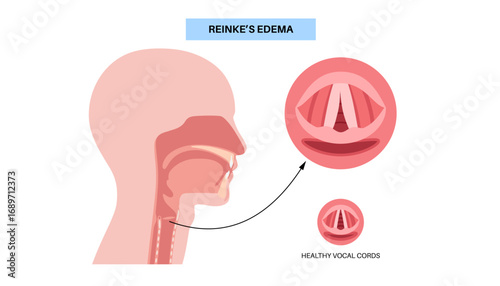 Reinkes edema poster