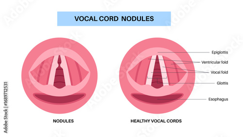 Vocal cord nodules