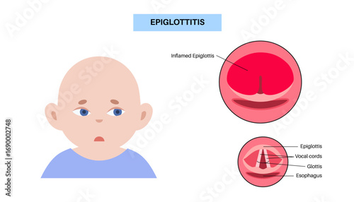 Epiglottitis medical poster