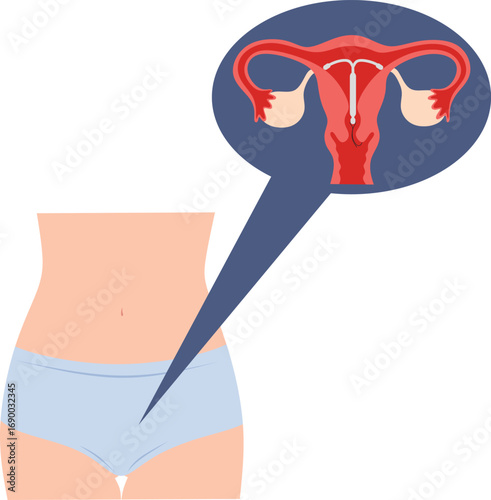 Intrauterine device (IUD) in female anatomy