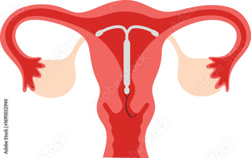 Illustration of intrauterine contraceptive device (IUD) installation