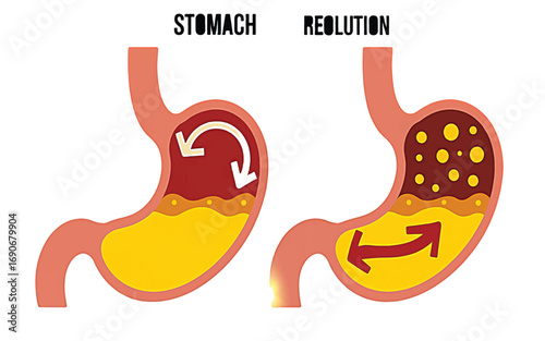 A medical vector illustration demonstrating the process of digestion and the soothing resolution of gastric contents within the human stomach
