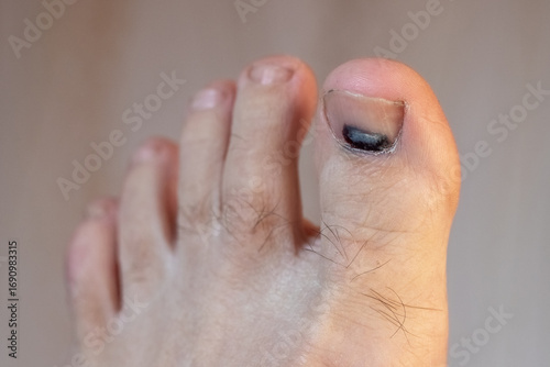 Photography Toe with subungual hematoma after injury, close up of toenail with dark spot, me