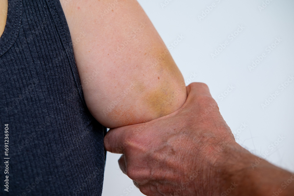Naklejka premium Female hand with big bruise, tightly grabbed by male hand, victim aggression, aggression, abuse concept, domestic physical violence, injured woman, fear expression