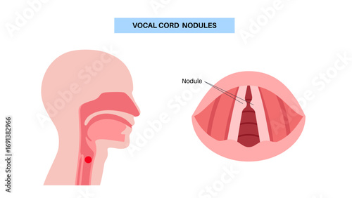 Vocal cord nodules