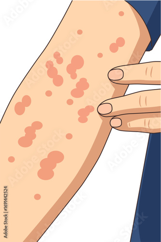 Vector illustration people experiencing allergy, dermatology design, allergic reaction from insect bites, red itchy spots, urticaria, kaligata. Flat design hand scratching the itch. Allergy symptoms.
