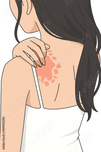 Vector illustration young woman experiencing an allergy, dermatology design, allergic reaction from insect bites on her back, hand scratching the itch, red itchy spots, urticaria, kaligata, irritation