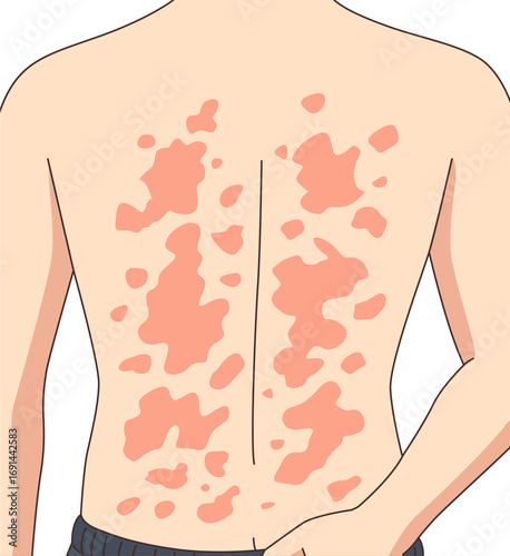 Vector illustration people experiencing allergy on his back, dermatology design, allergic reaction from insect bites, red itchy spots, urticaria, kaligata. Flat design allergy symptoms, sensitive skin
