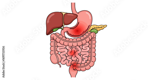 Human Digestive System with Highlighted Areas of Pain and Inflammation Illustrating Gastrointestinal Illnesses