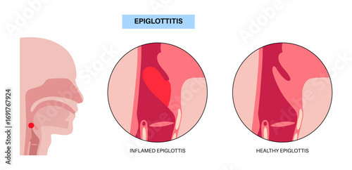 Epiglottitis medical poster