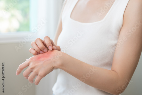 Wallpaper Mural Dermatology asian young woman allergy, allergic reaction from atopic, insect bite, scratching itchy back of hand, red spot or rash of skin. Healthcare treatment of beauty. Isolated on white background Torontodigital.ca