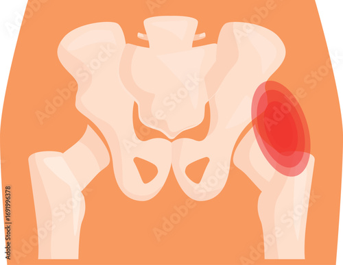 Medical illustration representing a painful hip joint highlighted in red on a pelvic x ray