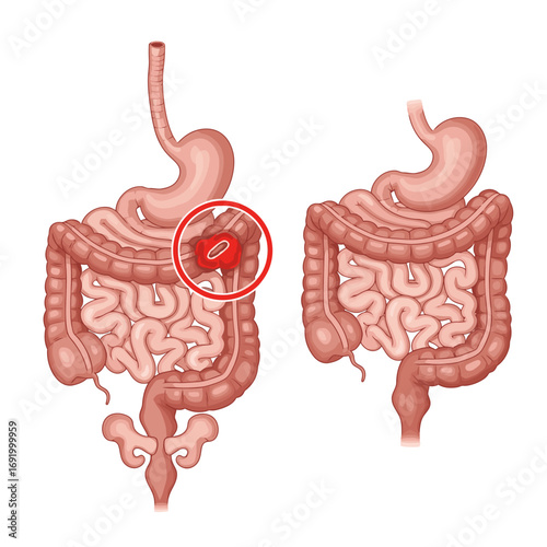 Detailed Medical Illustration Comparing Healthy Human Digestive System with Intestinal Obstruction