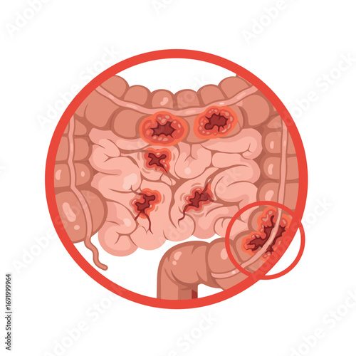 Medical Illustration of Inflamed Human Intestines with Ulcers and Lesions, Depicting Digestive System Diseases