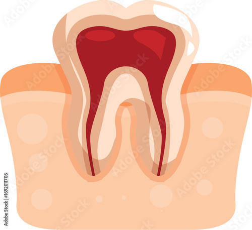 Cross section of molar tooth showing pulpitis with inflamed pulp and root canals