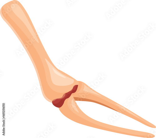 Broken arm bone presenting a radius and ulna fracture with injury, ideal for medical and healthcare related themes