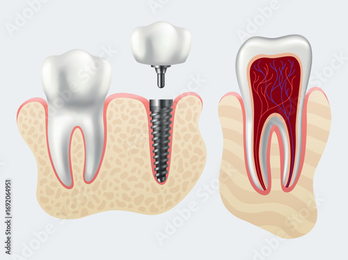 Dental implant structure. Medical educative infographic poster. Teeth implant, realistic vector design of dentistry. Implant screw, healthcare, dentist and orthodontist treatment