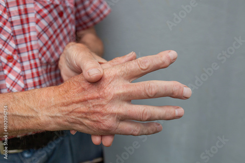 Close-up of an elderly Caucasian man's hands showing signs of rheumatoid arthritis. The hands are swollen and fingers are slightly bent, indicating discomfort.