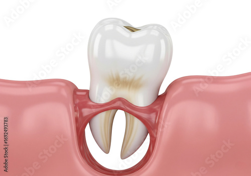 Dental Tooth Extraction: 3D Illustration of a Removed Tooth with Exposed Roots and Alveolar Socket, Highlighting Oral Surgery