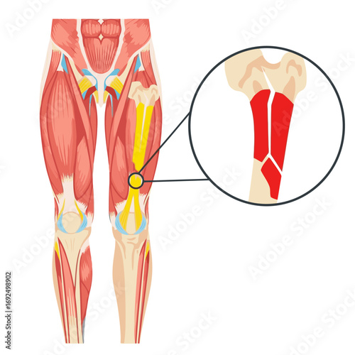 Comprehensive Human Leg Anatomy Illustration Highlighting a Femur Bone Fracture for Medical Education and Healthcare