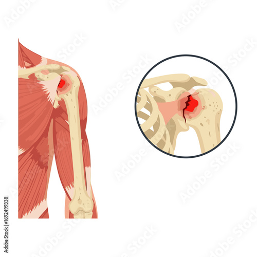 Anatomical illustration of a human shoulder joint displaying a painful injury or fracture, with detailed bone and muscle