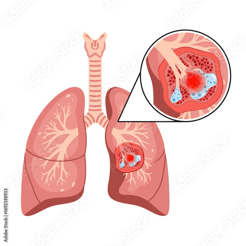 Detailed Medical Illustration of Lung Cancer with Magnified View of Malignant Tumor and Alveoli Damage