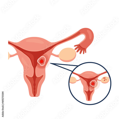 Medical Illustration of Uterine Fibroids