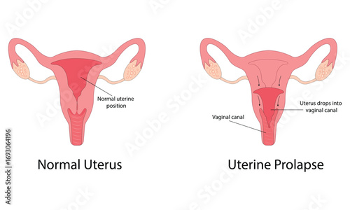 Uterine prolapse vector illustration