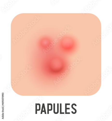Papules vector illustration. Acne type. Vector 3d clipart