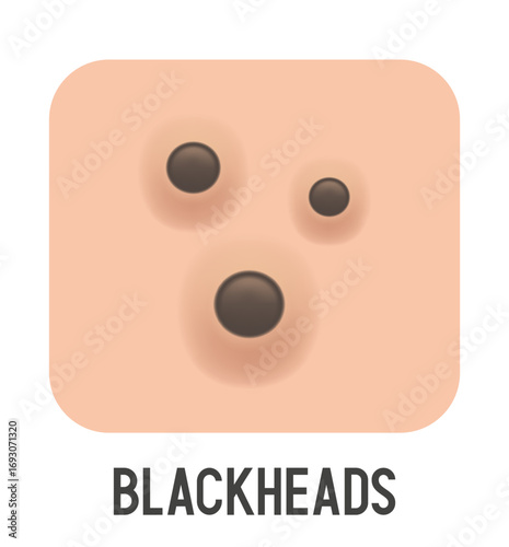 Blackheads vector illustration. Acne type. Vector 3d clipart