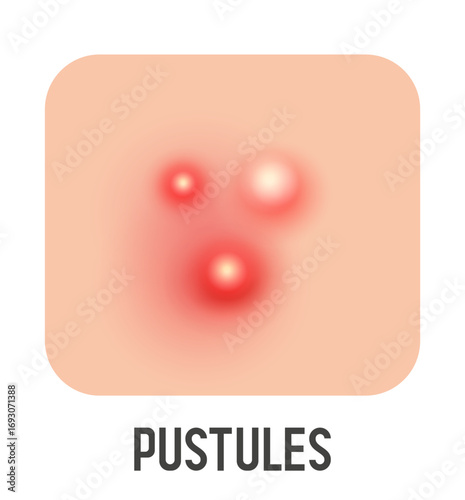 Pustule vector illustration. Acne type. Vector 3d clipart