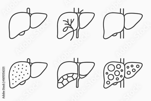 Diagram depicting six stages of liver disease and health anatomy