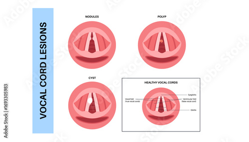 Vocal cord lesions