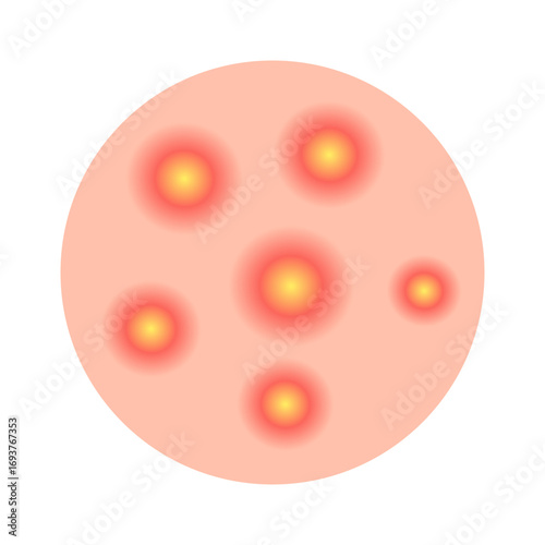 Acne facial type concept. vector illustration