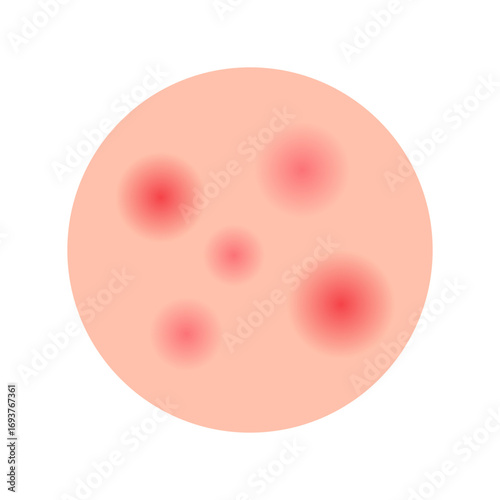 Acne facial type concept. vector illustration