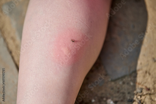Red, swollen mosquito bite visible on leg during daylight. Outdoor setting with rough ground background. Shot captures discomfort and irritation from side angle