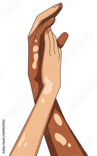 Portrait hands of vitiligo sufferers with different skin tones. Unique skin pigmentation highlighting natural beauty. World vitiligo day. Skin depigmentation, skin disorder.